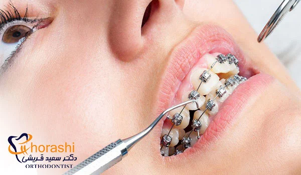 نصب بریس ارتودنسی در سی سالگی