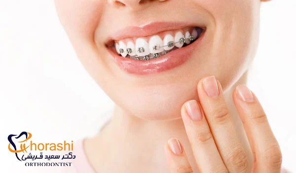 ارتودنسی ثابت در سن 30 سالگی