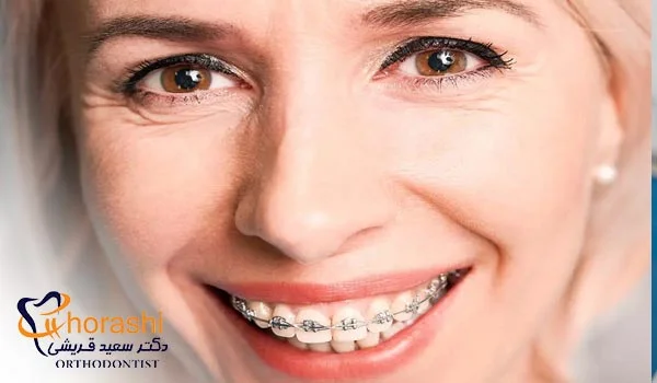 ارتودنسی ثابت در 50 سالگی