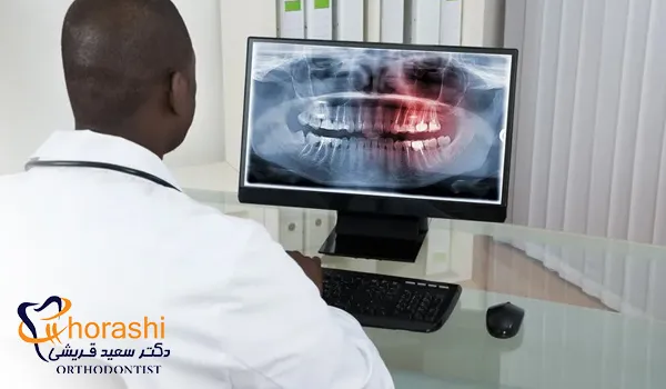 مدل سازی سه بعدی دندان ها در فرآیند ارتودنسی دیجیتال