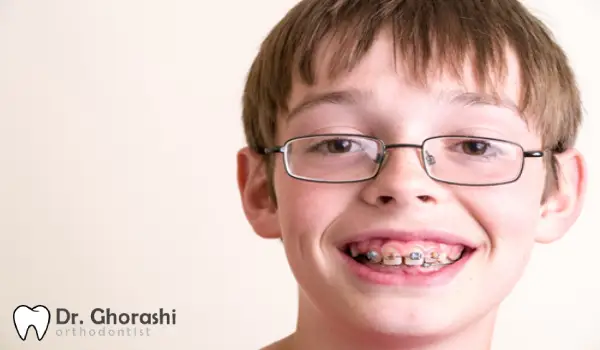 ارتودنسی برای دندان های شیری