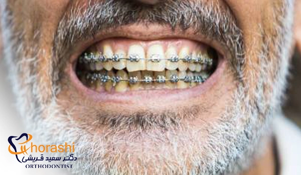 ارتودنسی ثابت فلزی در سن بالا