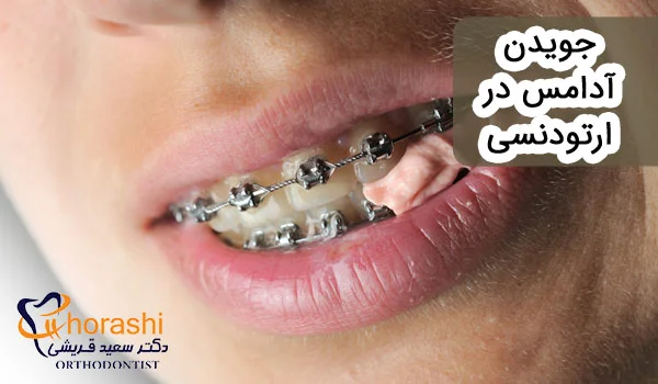 جویدن آدامس در ارتودنسی
