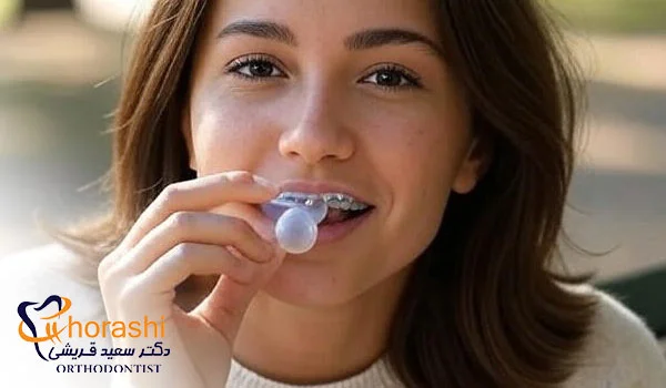 خوردن آدامس با بریس ثابت ارتودنسی