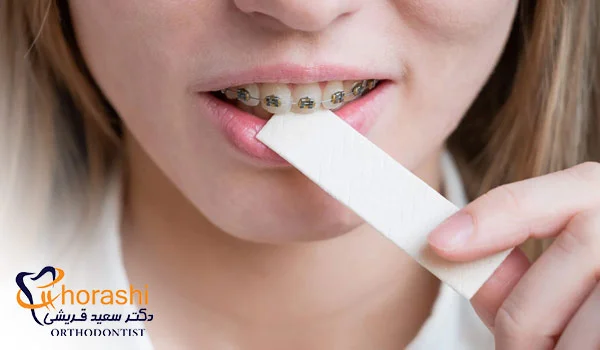 مضرات جوید آدامس برای ارتودنسی ثابت