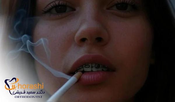 کشیدن سیگار با ارتودنسی