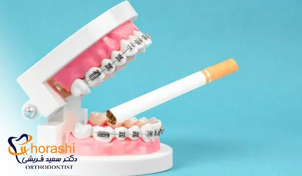 سیگار و ارتودنسی