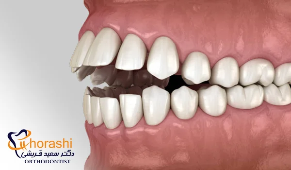 تاثیر ناهنجاری اپن بایت بر تکلم