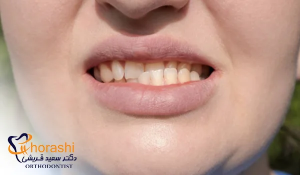 تاثیر ناهنجاری‌های فکی بر صحبت کردن