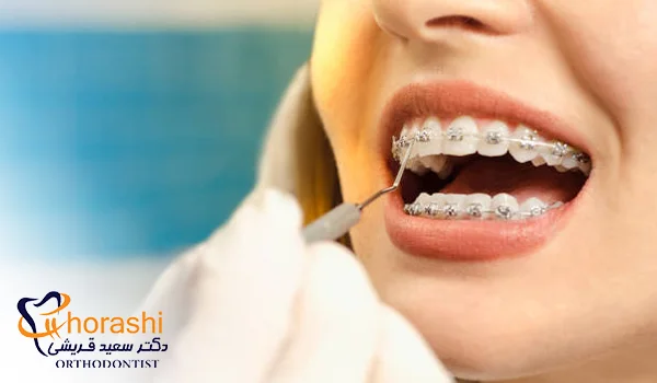 تاثیر ارتونسی ثابت بر تکلم
