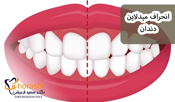 انحراف میدلاین دندان