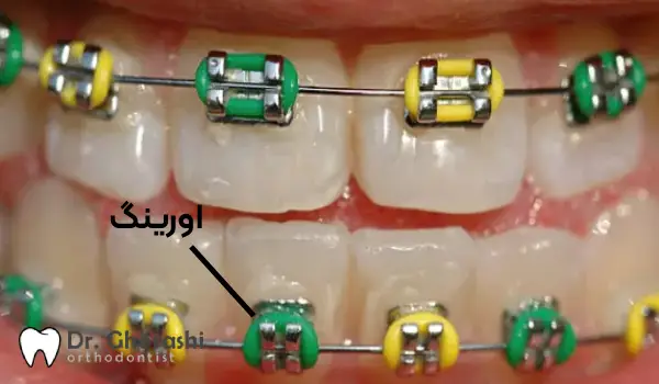 اورینگ ارتودنسی