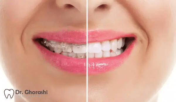 بلیچینگ در خانه بعد از ارتودنسی