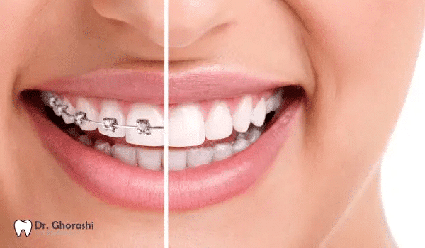 بلیچینگ بعد ارتودنسی
