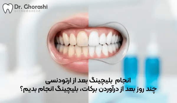 بلیچینگ بعد از ارتودنسی