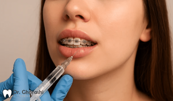 تزریق ژل لب حین ارتودنسی