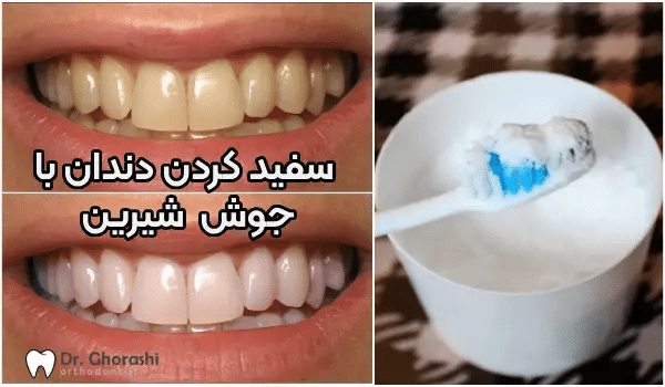 سفید کردن دندان با جوش شیرین