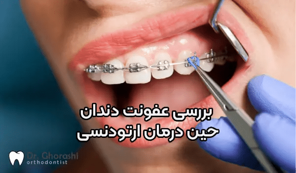 عفونت دندان حین ارتودنسی