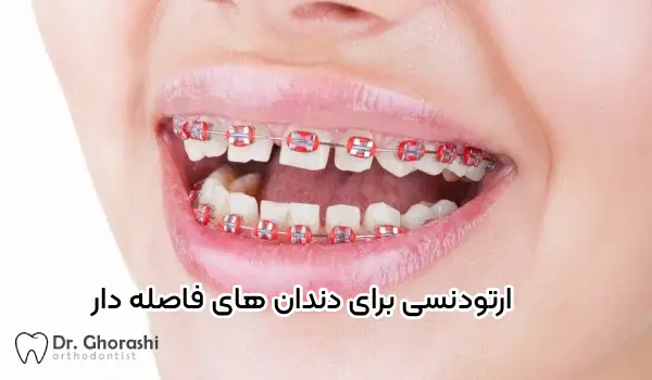 ارتودنسی دندان فاصله دار