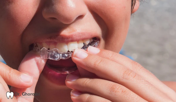 چالش های ارتودنسی نامرئی برای کودکان
