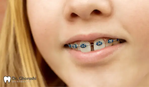 بستن فاصله دندان با ارتودنسی