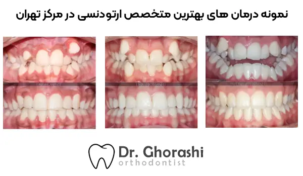 نمونه درمان های بهترین متخصص ارتودنسی در مرکز تهران