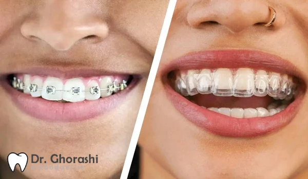 ارتودنسی نامرئی چرا از سیمی بهتر است؟