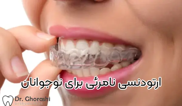 ارتودنسی نامرئی برای نوجوانان