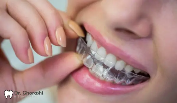 Golden tips for maintaining invisible orthodontics