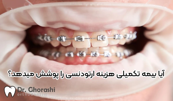 هزینه ارتودنسی با بیمه تکمیلی