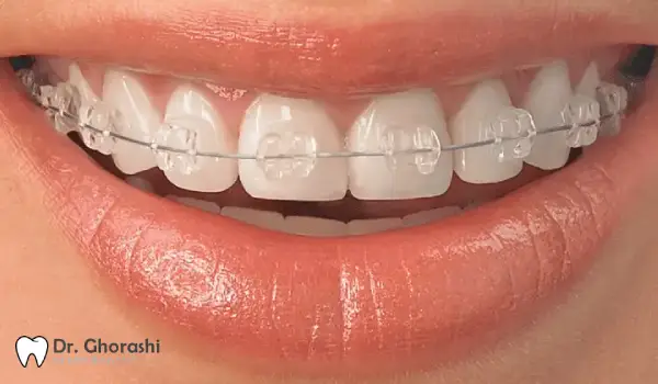 براکت سلف لیگیت