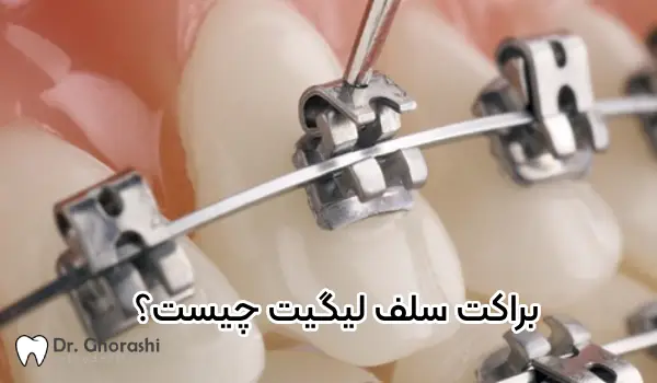 براکت سلف لیگیت چیست؟