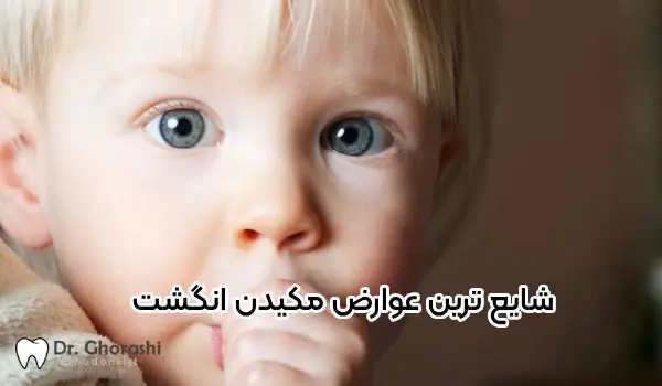 عوارض مکیدن انگشت در کودکان