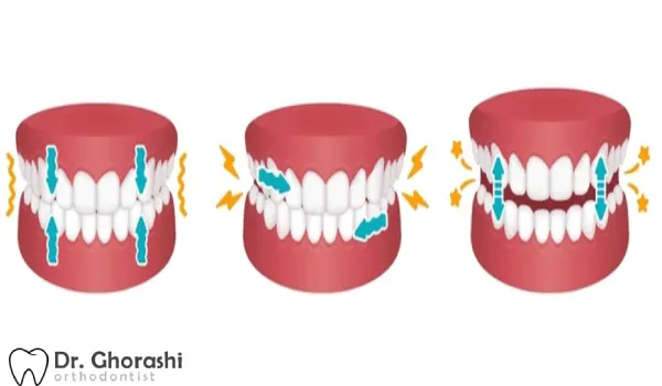 دندان قروچه