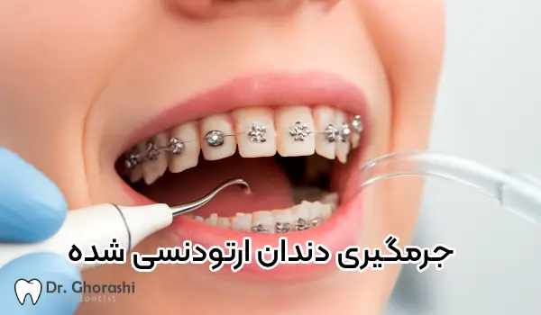 جرمیگیری دندان با ارتودنسی