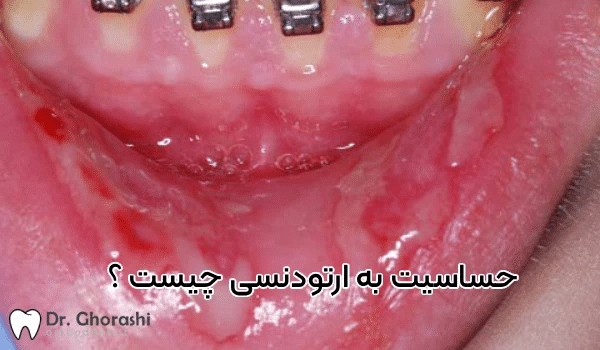 حساسیت به بریس ارتودنسی