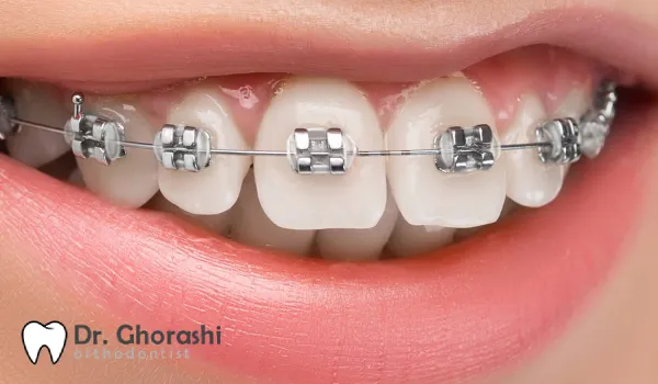 انتخاب لیگاچور مناسب برای شما