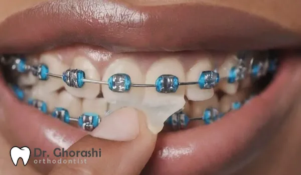 تناول شمع تقويم الأسنان