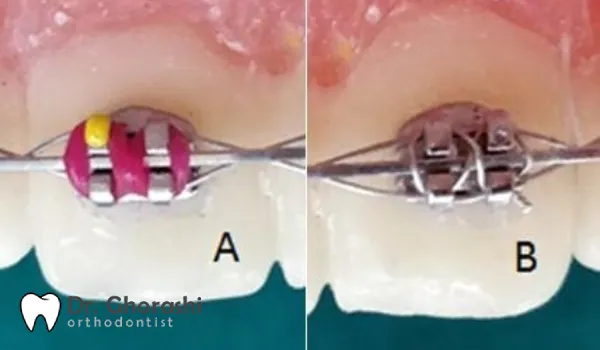 انواع لیگاچور ارتودنسی