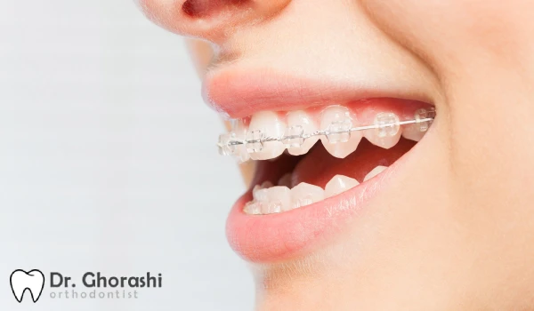 انواع سیم قوس دار ارتودنسی