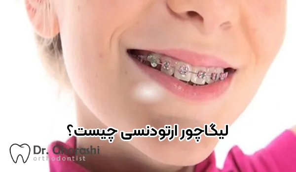 لیگاچور ارتودنسی چیست؟