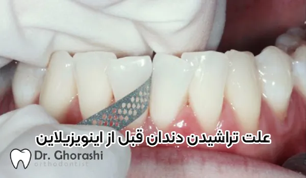 علت تراشیدن دندان قبل از اینویزیلاین