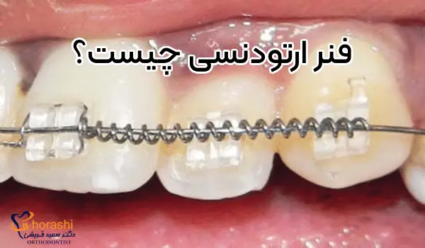 کویل اسپرینگ یا فنر ارتودنسی چیست؟