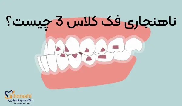 ناهنجاری فک کلاس 3 چیست؟