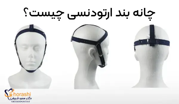 چانه بند ارتودنسی چیست؟