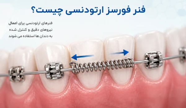 فنر فورسز در ارتودنسی