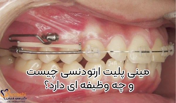 مینی پلیت ارتودنسی چیست و چگونه کار می کند؟