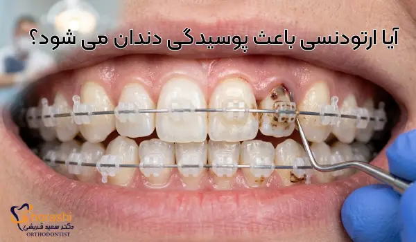 آیا ارتودنسی باعث پوسیدگی دندان می شود؟