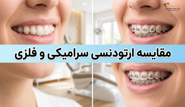 ارتودنسی سرامیکی مناسب تر است یا ارتودنسی ساده؟