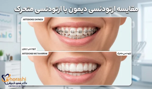 مقایسه ارتودنسی دیمون و متحرک